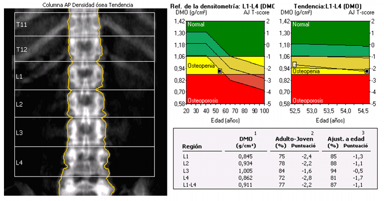 Bone Densitometry