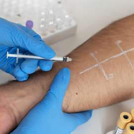 Intradermal skin sensitivity tests