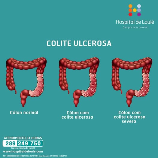 Ulcerative colitis