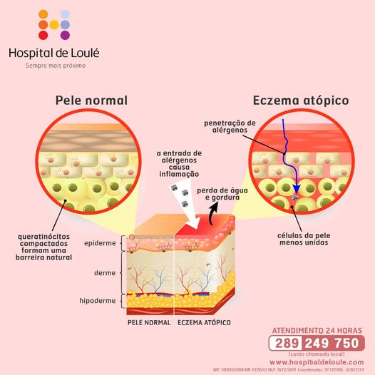 Atopic eczema