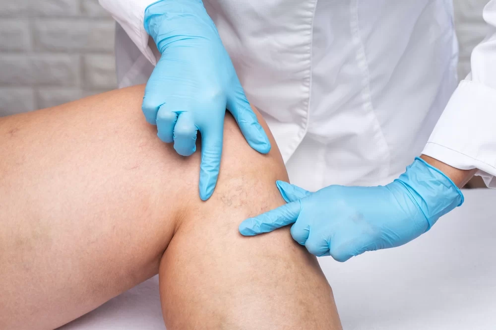 Sclerotherapy