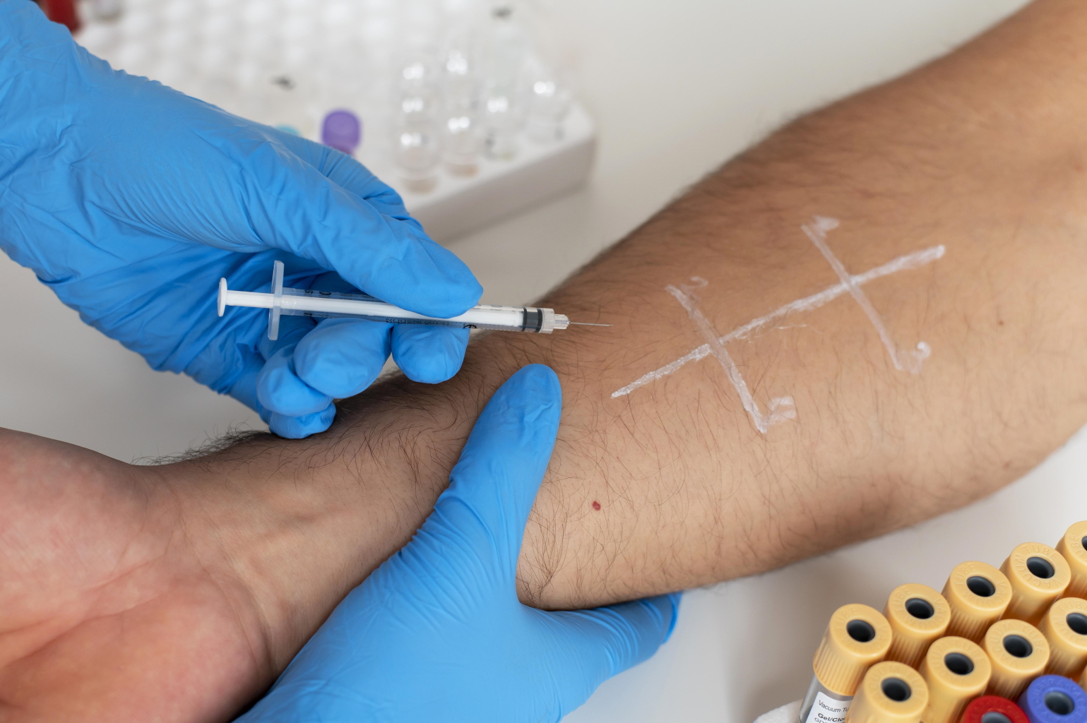 Intradermal skin sensitivity tests