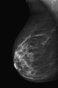 Digital Mammography